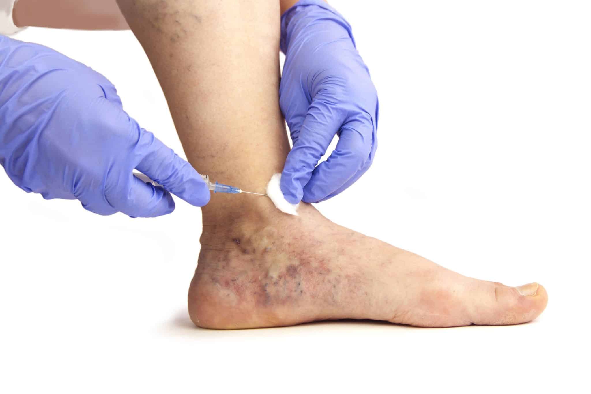 Can Varicose Veins Cause Foot Cramps