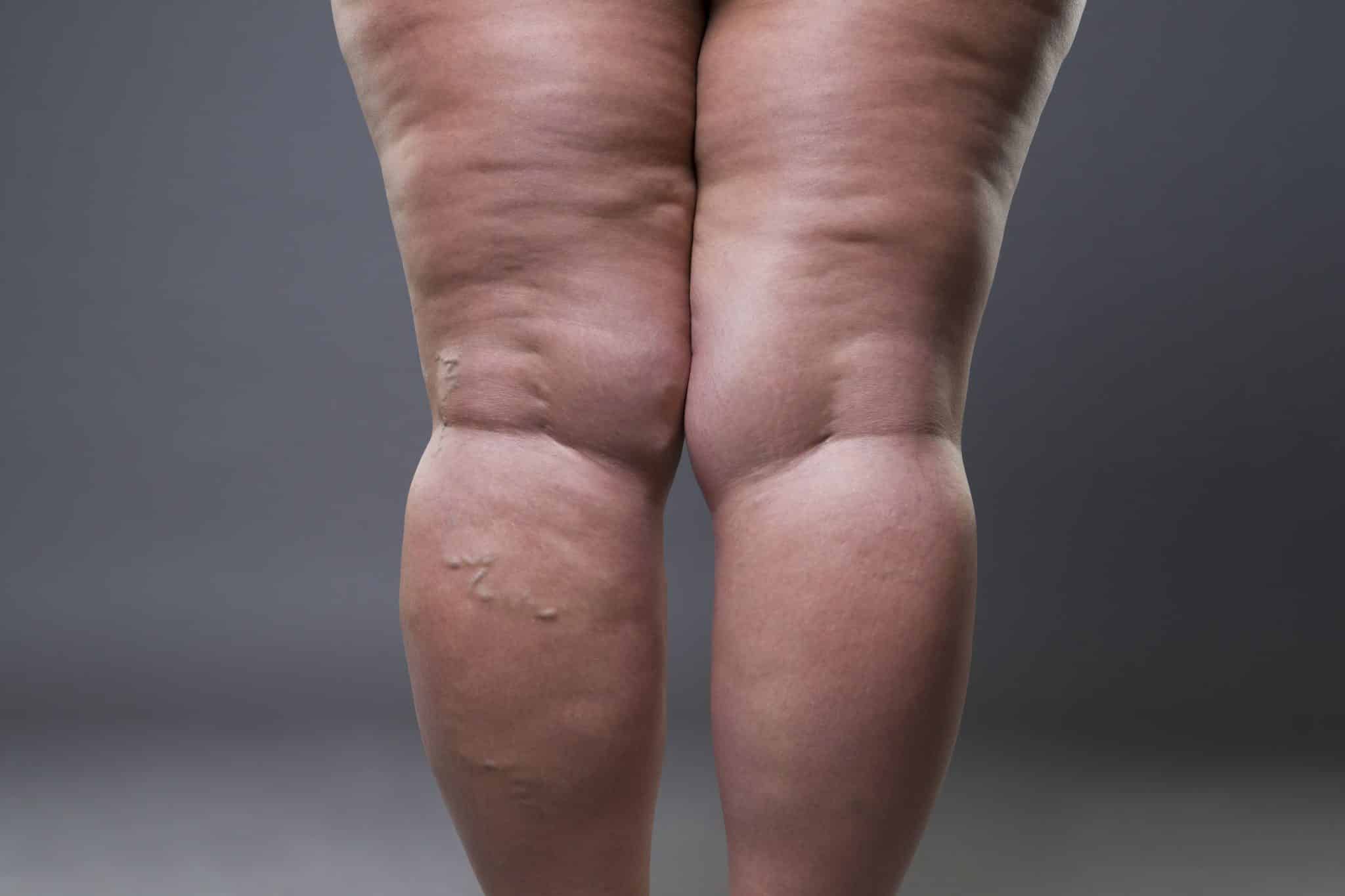 varicose veins closeup